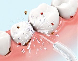 Best Water Flosser